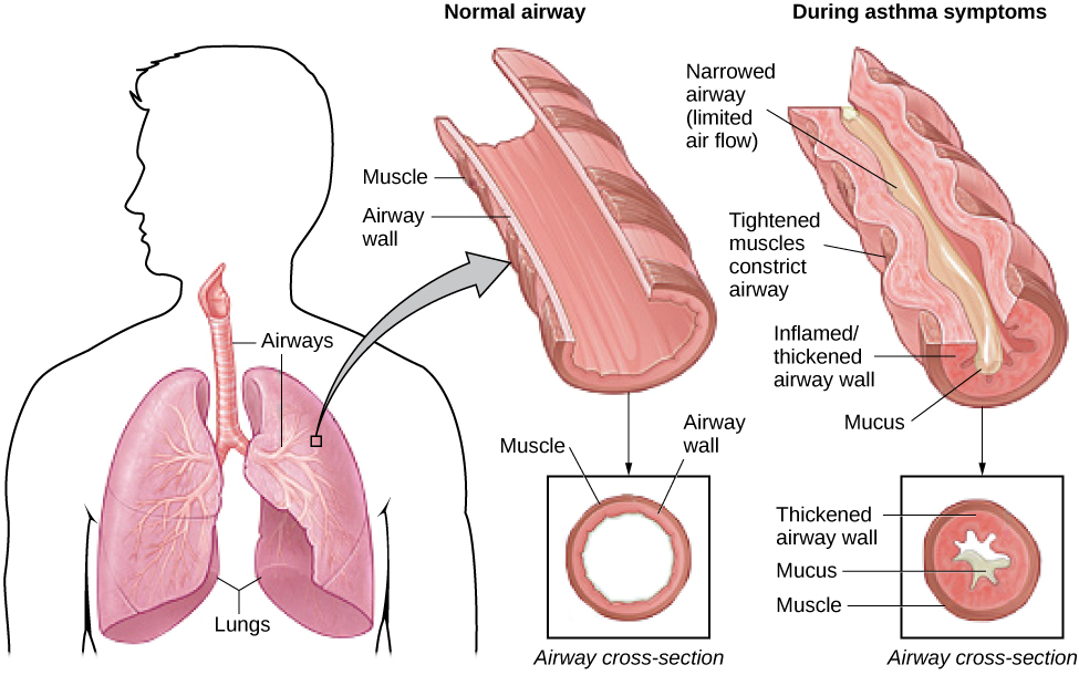 The effect of asthma on airways is illustrated. A silhouette of a person is shown with the lungs and airways labeled. There is an arrow coming from an airway in the lung leading to a magnification of a normal airway. A cross-section of the normal airway shows the muscle and the airway wall, with plenty of room for air to get through. An airway during asthma symptoms is also shown, and the labeled symptoms are narrowed airway (limited air flow), tightened muscles constrict airway, inflamed/thickened airway wall, and mucus. A cross-section of the airway during asthma symptoms shows the thickened airway wall, mucus and muscle. There is much less room for air to get through.